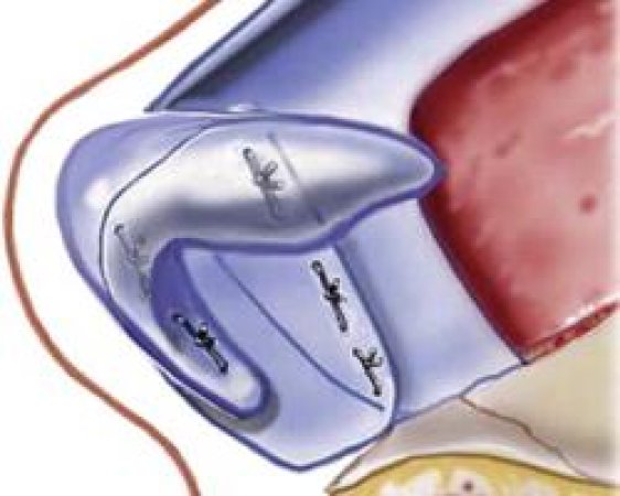 rhinoplasty-64